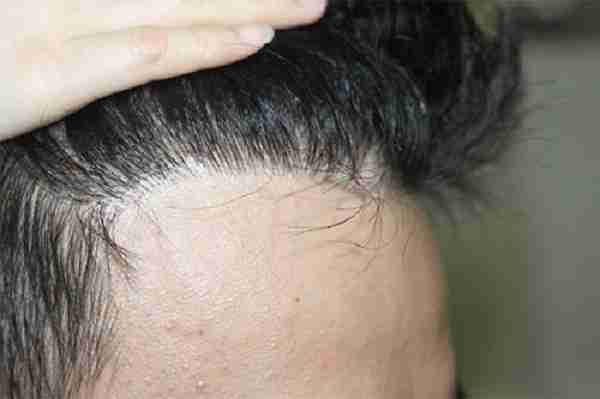 防止脱发最有效的方法有哪些